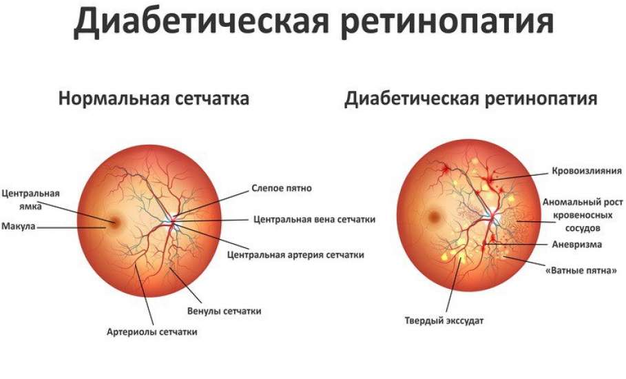 Диабетическая ретинопатия | Больница Dünyagöz